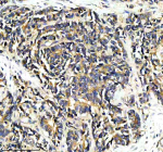 Immunohistochemical staining of PPP2R5E using anti-PPP2R5E antibody. PPP2R5E was detected in a paraffin-embedded section of human colon cancer tissue. Heat mediated antigen retrieval was performed in EDTA buffer (pH 8.0, epitope retrieval solution). The tissue section was blocked with 10% goat serum. The tissue section was then incubated with 2 ug/ml rabbit anti-PPP2R5E antibody overnight at 4oC. Peroxidase Conjugated Goat Anti-rabbit IgG was used as secondary antibody and incubated for 30 minutes at 37oC. The tissue section was developed using an HRP secondary and DAB substrate.