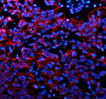 Immunofluorescent staining of P2RX1 using anti-P2RX1 antibody (red). P2RX1 was detected in a paraffin-embedded section of human bladder cancer tissue. Heat mediated antigen retrieval was performed in EDTA buffer (pH 8.0, epitope retrieval solution). The tissue section was blocked with 10% goat serum. The tissue section was then incubated with 5 ug/ml rabbit anti-P2RX1 antibody overnight at 4oC. Cy3 Conjugated Goat Anti-Rabbit IgG was used as secondary antibody at 1:500 dilution and incubated for 30 minutes at 37oC. The section was counterstained with DAPI nuclear stain (blue). Visualize using a fluorescence microscope and filter sets appropriate for the label used.