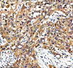 Immunohistochemical staining of NAGK using anti-NAGK antibody. NAGK was detected in a paraffin-embedded section of human bladder cancer tissue. Heat mediated antigen retrieval was performed in EDTA buffer (pH 8.0, epitope retrieval solution). The tissue section was blocked with 10% goat serum. The tissue section was then incubated with 2 ug/ml rabbit anti-NAGK antibody overnight at 4oC. Peroxidase Conjugated Goat Anti-rabbit IgG was used as secondary antibody and incubated for 30 minutes at 37oC. The tissue section was developed using an HRP secondary and DAB substrate.