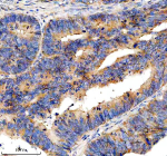 Immunohistochemical staining of EIF3H using anti-EIF3H antibody. EIF3H was detected in a paraffin-embedded section of human colon cancer tissue. Heat mediated antigen retrieval was performed in EDTA buffer (pH 8.0, epitope retrieval solution). The tissue section was blocked with 10% goat serum. The tissue section was then incubated with 2 ug/ml rabbit anti-EIF3H antibody overnight at 4oC. Peroxidase Conjugated Goat Anti-rabbit IgG was used as secondary antibody and incubated for 30 minutes at 37oC. The tissue section was developed using an HRP secondary and DAB substrate.