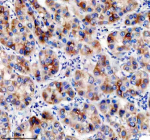 Immunohistochemical staining of TNFRSF10D using anti-TNFRSF10D antibody. TNFRSF10D was detected in a paraffin-embedded section of human liver cancer tissue. Heat mediated antigen retrieval was performed in EDTA buffer (pH 8.0, epitope retrieval solution). The tissue section was blocked with 10% goat serum. The tissue section was then incubated with 2 ug/ml rabbit anti-TNFRSF10D antibody overnight at 4oC. Peroxidase Conjugated Goat Anti-rabbit IgG was used as secondary antibody and incubated for 30 minutes at 37oC. The tissue section was developed using an HRP secondary and DAB substrate.