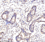 Immunohistochemical staining of Lamin B2 using anti-Lamin B2 antibody. Lamin B2 was detected in a paraffin-embedded section of human colon cancer tissue. Heat mediated antigen retrieval was performed in EDTA buffer (pH 8.0, epitope retrieval solution). The tissue section was blocked with 10% goat serum. The tissue section was then incubated with 2 ug/ml rabbit anti-Lamin B2 antibody overnight at 4oC. Peroxidase Conjugated Goat Anti-rabbit IgG was used as secondary antibody and incubated for 30 minutes at 37oC. The tissue section was developed using an HRP secondary and DAB substrate.