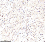 Immunohistochemical staining of Lamin B2 using anti-Lamin B2 antibody. Lamin B2 was detected in a paraffin-embedded section of human bladder cancer tissue. Heat mediated antigen retrieval was performed in EDTA buffer (pH 8.0, epitope retrieval solution). The tissue section was blocked with 10% goat serum. The tissue section was then incubated with 2 ug/ml rabbit anti-Lamin B2 antibody overnight at 4oC. Peroxidase Conjugated Goat Anti-rabbit IgG was used as secondary antibody and incubated for 30 minutes at 37oC. The tissue section was developed using an HRP secondary and DAB substrate.