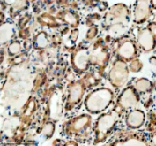Immunohistochemical staining of SMARCAL1 using anti-SMARCAL1 antibody. SMARCAL1 was detected in a paraffin-embedded section of human thyroid cancer tissue. Heat mediated antigen retrieval was performed in EDTA buffer (pH 8.0, epitope retrieval solution). The tissue section was blocked with 10% goat serum. The tissue section was then incubated with 2 ug/ml rabbit anti-SMARCAL1 antibody overnight at 4oC. Peroxidase Conjugated Goat Anti-rabbit IgG was used as secondary antibody and incubated for 30 minutes at 37oC. The tissue section was developed using an HRP secondary and DAB substrate.