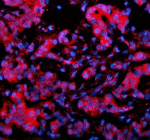 Immunofluorescent staining of SLX4 using anti-SLX4 antibody (red). SLX4 was detected in a paraffin-embedded section of human breast cancer tissue. Heat mediated antigen retrieval was performed in EDTA buffer (pH 8.0, epitope retrieval solution). The tissue section was blocked with 10% goat serum. The tissue section was then incubated with 5 ug/ml rabbit anti-SLX4 antibody overnight at 4oC. Cy3 Conjugated Goat Anti-Rabbit IgG was used as secondary antibody at 1:500 dilution and incubated for 30 minutes at 37oC. The section was counterstained with DAPI nuclear stain (blue). Visualize using a fluorescence microscope and filter sets appropriate for the label used.