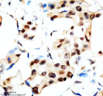 Immunohistochemical staining of SLX4 using anti-SLX4 antibody. SLX4 was detected in a paraffin-embedded section of human breast cancer tissue. Heat mediated antigen retrieval was performed in EDTA buffer (pH 8.0, epitope retrieval solution). The tissue section was blocked with 10% goat serum. The tissue section was then incubated with 2 ug/ml rabbit anti-SLX4 antibody overnight at 4oC. Peroxidase Conjugated Goat Anti-rabbit IgG was used as secondary antibody and incubated for 30 minutes at 37oC. The tissue section was developed using an HRP secondary and DAB substrate.