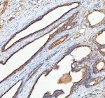 Immunohistochemical staining of RHOT2 using anti-RHOT2 antibody. RHOT2 was detected in a paraffin-embedded section of human prostate cancer tissue. Heat mediated antigen retrieval was performed in EDTA buffer (pH 8.0, epitope retrieval solution). The tissue section was blocked with 10% goat serum. The tissue section was then incubated with 2 ug/ml rabbit anti-RHOT2 antibody overnight at 4oC. Peroxidase Conjugated Goat Anti-rabbit IgG was used as secondary antibody and incubated for 30 minutes at 37oC. The tissue section was developed using an HRP secondary and DAB substrate.