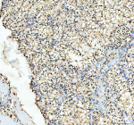Immunohistochemical staining of RHOT2 using anti-RHOT2 antibody. RHOT2 was detected in a paraffin-embedded section of human renal cancer tissue. Heat mediated antigen retrieval was performed in EDTA buffer (pH 8.0, epitope retrieval solution). The tissue section was blocked with 10% goat serum. The tissue section was then incubated with 2 ug/ml rabbit anti-RHOT2 antibody overnight at 4oC. Peroxidase Conjugated Goat Anti-rabbit IgG was used as secondary antibody and incubated for 30 minutes at 37oC. The tissue section was developed using an HRP secondary and DAB substrate.