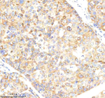 Immunohistochemical staining of NCLN using anti-NCLN antibody. NCLN was detected in a paraffin-embedded section of human liver cancer tissue. Heat mediated antigen retrieval was performed in EDTA buffer (pH 8.0, epitope retrieval solution). The tissue section was blocked with 10% goat serum. The tissue section was then incubated with 2 ug/ml rabbit anti-NCLN antibody overnight at 4oC. Peroxidase Conjugated Goat Anti-rabbit IgG was used as secondary antibody and incubated for 30 minutes at 37oC. The tissue section was developed using an HRP secondary and DAB substrate.