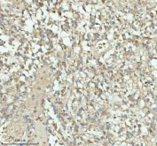 Immunohistochemical staining of PACSIN1 using anti-PACSIN1 antibody. PACSIN1 was detected in a paraffin-embedded section of human glioblastoma tissue. Heat mediated antigen retrieval was performed in EDTA buffer (pH 8.0, epitope retrieval solution). The tissue section was blocked with 10% goat serum. The tissue section was then incubated with 2 ug/ml rabbit anti-PACSIN1 antibody overnight at 4oC. Peroxidase Conjugated Goat Anti-rabbit IgG was used as secondary antibody and incubated for 30 minutes at 37oC. The tissue section was developed using an HRP secondary and DAB substrate.
