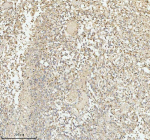 Immunohistochemical staining of PACSIN1 using anti-PACSIN1 antibody. PACSIN1 was detected in a paraffin-embedded section of human glioblastoma tissue. Heat mediated antigen retrieval was performed in EDTA buffer (pH 8.0, epitope retrieval solution). The tissue section was blocked with 10% goat serum. The tissue section was then incubated with 2 ug/ml rabbit anti-PACSIN1 antibody overnight at 4oC. Peroxidase Conjugated Goat Anti-rabbit IgG was used as secondary antibody and incubated for 30 minutes at 37oC. The tissue section was developed using an HRP secondary and DAB substrate.