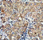 Immunohistochemical staining of SIGIRR using anti-SIGIRR antibody. SIGIRR was detected in a paraffin-embedded section of human liver cancer tissue. Heat mediated antigen retrieval was performed in EDTA buffer (pH 8.0, epitope retrieval solution). The tissue section was blocked with 10% goat serum. The tissue section was then incubated with 2 ug/ml rabbit anti-SIGIRR antibody overnight at 4oC. Peroxidase Conjugated Goat Anti-rabbit IgG was used as secondary antibody and incubated for 30 minutes at 37oC. The tissue section was developed using an HRP secondary and DAB substrate.