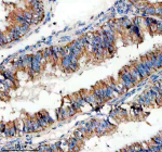 Immunohistochemical staining of SIGIRR using anti-SIGIRR antibody. SIGIRR was detected in a paraffin-embedded section of human endometrial cancer tissue. Heat mediated antigen retrieval was performed in EDTA buffer (pH 8.0, epitope retrieval solution). The tissue section was blocked with 10% goat serum. The tissue section was then incubated with 2 ug/ml rabbit anti-SIGIRR antibody overnight at 4oC. Peroxidase Conjugated Goat Anti-rabbit IgG was used as secondary antibody and incubated for 30 minutes at 37oC. The tissue section was developed using an HRP secondary and DAB substrate.