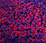 Immunofluorescent staining of SIGIRR using anti-SIGIRR antibody (red). SIGIRR was detected in a paraffin-embedded section of human liver cancer tissue. Heat mediated antigen retrieval was performed in EDTA buffer (pH 8.0, epitope retrieval solution). The tissue section was blocked with 10% goat serum. The tissue section was then incubated with 5 ug/ml rabbit anti-SIGIRR antibody overnight at 4oC. Cy3 Conjugated Goat Anti-Rabbit IgG was used as secondary antibody at 1:500 dilution and incubated for 30 minutes at 37oC. The section was counterstained with DAPI nuclear stain (blue). Visualize using a fluorescence microscope and filter sets appropriate for the label used.