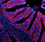 Immunofluorescent staining of SIGIRR using anti-SIGIRR antibody (red). SIGIRR was detected in a paraffin-embedded section of human endometrial cancer tissue. Heat mediated antigen retrieval was performed in EDTA buffer (pH 8.0, epitope retrieval solution). The tissue section was blocked with 10% goat serum. The tissue section was then incubated with 5 ug/ml rabbit anti-SIGIRR antibody overnight at 4oC. Cy3 Conjugated Goat Anti-Rabbit IgG was used as secondary antibody at 1:500 dilution and incubated for 30 minutes at 37oC. The section was counterstained with DAPI nuclear stain (blue). Visualize using a fluorescence microscope and filter sets appropriate for the label used.