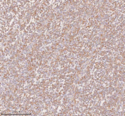 Immunohistochemical staining of SLC14A1 using anti-SLC14A1 antibody. SLC14A1 was detected in a paraffin-embedded section of human melanoma tissue. Heat mediated antigen retrieval was performed in EDTA buffer (pH 8.0, epitope retrieval solution). The tissue section was blocked with 10% goat serum. The tissue section was then incubated with 2 ug/ml rabbit anti-SLC14A1 antibody overnight at 4oC. Peroxidase Conjugated Goat Anti-rabbit IgG was used as secondary antibody and incubated for 30 minutes at 37oC. The tissue section was developed using an HRP secondary and DAB substrate.
