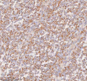 Immunohistochemical staining of SLC14A1 using anti-SLC14A1 antibody. SLC14A1 was detected in a paraffin-embedded section of human melanoma tissue. Heat mediated antigen retrieval was performed in EDTA buffer (pH 8.0, epitope retrieval solution). The tissue section was blocked with 10% goat serum. The tissue section was then incubated with 2 ug/ml rabbit anti-SLC14A1 antibody overnight at 4oC. Peroxidase Conjugated Goat Anti-rabbit IgG was used as secondary antibody and incubated for 30 minutes at 37oC. The tissue section was developed using an HRP secondary and DAB substrate.