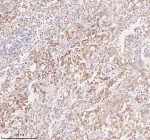Immunohistochemical staining of SLC14A1 using anti-SLC14A1 antibody. SLC14A1 was detected in a paraffin-embedded section of human pancreatic cancer tissue. Heat mediated antigen retrieval was performed in EDTA buffer (pH 8.0, epitope retrieval solution). The tissue section was blocked with 10% goat serum. The tissue section was then incubated with 2 ug/ml rabbit anti-SLC14A1 antibody overnight at 4oC. Peroxidase Conjugated Goat Anti-rabbit IgG was used as secondary antibody and incubated for 30 minutes at 37oC. The tissue section was developed using an HRP secondary and DAB substrate.