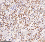 Immunohistochemical staining of SLC14A1 using anti-SLC14A1 antibody. SLC14A1 was detected in a paraffin-embedded section of human pancreatic cancer tissue. Heat mediated antigen retrieval was performed in EDTA buffer (pH 8.0, epitope retrieval solution). The tissue section was blocked with 10% goat serum. The tissue section was then incubated with 2 ug/ml rabbit anti-SLC14A1 antibody overnight at 4oC. Peroxidase Conjugated Goat Anti-rabbit IgG was used as secondary antibody and incubated for 30 minutes at 37oC. The tissue section was developed using an HRP secondary and DAB substrate.