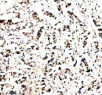 Immunohistochemical staining of MAML3 using anti-MAML3 antibody. MAML3 was detected in a paraffin-embedded section of human breast cancer tissue. Heat mediated antigen retrieval was performed in EDTA buffer (pH 8.0, epitope retrieval solution). The tissue section was blocked with 10% goat serum. The tissue section was then incubated with 2 ug/ml rabbit anti-MAML3 antibody overnight at 4oC. Peroxidase Conjugated Goat Anti-rabbit IgG was used as secondary antibody and incubated for 30 minutes at 37oC. The tissue section was developed using an HRP secondary and DAB substrate.