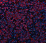 Immunofluorescent staining of MAML3 using anti-MAML3 antibody (red). MAML3 was detected in a paraffin-embedded section of human bladder cancer tissue. Heat mediated antigen retrieval was performed in EDTA buffer (pH 8.0, epitope retrieval solution). The tissue section was blocked with 10% goat serum. The tissue section was then incubated with 5 ug/ml rabbit anti-MAML3 antibody overnight at 4oC. Cy3 Conjugated Goat Anti-Rabbit IgG was used as secondary antibody at 1:500 dilution and incubated for 30 minutes at 37oC. The section was counterstained with DAPI nuclear stain (blue). Visualize using a fluorescence microscope and filter sets appropriate for the label used.