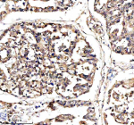 Immunohistochemical staining of DNAJB6 using anti-DNAJB6 antibody. DNAJB6 was detected in a paraffin-embedded section of human lung cancer tissue. Heat mediated antigen retrieval was performed in EDTA buffer (pH 8.0, epitope retrieval solution). The tissue section was blocked with 10% goat serum. The tissue section was then incubated with 2 ug/ml rabbit anti-DNAJB6 antibody overnight at 4oC. Peroxidase Conjugated Goat Anti-rabbit IgG was used as secondary antibody and incubated for 30 minutes at 37oC. The tissue section was developed using an HRP secondary and DAB substrate.