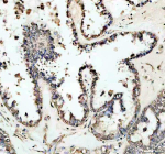 Immunohistochemical staining of NCOR2 using anti-NCOR2 antibody. NCOR2 was detected in a paraffin-embedded section of human ovarican cancer tissue. Heat mediated antigen retrieval was performed in EDTA buffer (pH 8.0, epitope retrieval solution). The tissue section was blocked with 10% goat serum. The tissue section was then incubated with 2 ug/ml rabbit anti-NCOR2 antibody overnight at 4oC. Peroxidase Conjugated Goat Anti-rabbit IgG was used as secondary antibody and incubated for 30 minutes at 37oC. The tissue section was developed using an HRP secondary and DAB substrate.