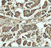 Immunohistochemical staining of NCOR2 using anti-NCOR2 antibody. NCOR2 was detected in a paraffin-embedded section of human breast cancer tissue. Heat mediated antigen retrieval was performed in EDTA buffer (pH 8.0, epitope retrieval solution). The tissue section was blocked with 10% goat serum. The tissue section was then incubated with 2 ug/ml rabbit anti-NCOR2 antibody overnight at 4oC. Peroxidase Conjugated Goat Anti-rabbit IgG was used as secondary antibody and incubated for 30 minutes at 37oC. The tissue section was developed using an HRP secondary and DAB substrate.