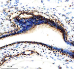 Immunohistochemical staining of NDUFS3 using anti-NDUFS3 antibody. NDUFS3 was detected in a paraffin-embedded section of human breast cancer tissue. Heat mediated antigen retrieval was performed in EDTA buffer (pH 8.0, epitope retrieval solution). The tissue section was blocked with 10% goat serum. The tissue section was then incubated with 2 ug/ml rabbit anti-NDUFS3 antibody overnight at 4oC. Peroxidase Conjugated Goat Anti-rabbit IgG was used as secondary antibody and incubated for 30 minutes at 37oC. The tissue section was developed using an HRP secondary and DAB substrate.