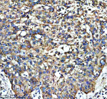 Immunohistochemical staining of SHMT2 using anti-SHMT2 antibody. SHMT2 was detected in a paraffin-embedded section of human bladder cancer tissue. Heat mediated antigen retrieval was performed in EDTA buffer (pH 8.0, epitope retrieval solution). The tissue section was blocked with 10% goat serum. The tissue section was then incubated with 2 ug/ml rabbit anti-SHMT2 antibody overnight at 4oC. Peroxidase Conjugated Goat Anti-rabbit IgG was used as secondary antibody and incubated for 30 minutes at 37oC. The tissue section was developed using an HRP secondary and DAB substrate.