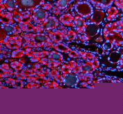 Immunofluorescent staining of FFPE human thyroid cancer tissue with SHMT2 antibody (red) and DAPI nuclear stain (blue). HIER: steam section in pH8 EDTA buffer for 20 min.