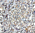 Immunohistochemical staining of SHMT2 using anti-SHMT2 antibody. SHMT2 was detected in a paraffin-embedded section of human lung cancer tissue. Heat mediated antigen retrieval was performed in EDTA buffer (pH 8.0, epitope retrieval solution). The tissue section was blocked with 10% goat serum. The tissue section was then incubated with 2 ug/ml rabbit anti-SHMT2 antibody overnight at 4oC. Peroxidase Conjugated Goat Anti-rabbit IgG was used as secondary antibody and incubated for 30 minutes at 37oC. The tissue section was developed using an HRP secondary and DAB substrate.