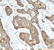 Immunohistochemical staining of SHMT2 using anti-SHMT2 antibody. SHMT2 was detected in a paraffin-embedded section of human liver cancer tissue. Heat mediated antigen retrieval was performed in EDTA buffer (pH 8.0, epitope retrieval solution). The tissue section was blocked with 10% goat serum. The tissue section was then incubated with 2 ug/ml rabbit anti-SHMT2 antibody overnight at 4oC. Peroxidase Conjugated Goat Anti-rabbit IgG was used as secondary antibody and incubated for 30 minutes at 37oC. The tissue section was developed using an HRP secondary and DAB substrate.