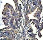 Immunohistochemical staining of SHMT2 using anti-SHMT2 antibody. SHMT2 was detected in a paraffin-embedded section of human colon cancer tissue. Heat mediated antigen retrieval was performed in EDTA buffer (pH 8.0, epitope retrieval solution). The tissue section was blocked with 10% goat serum. The tissue section was then incubated with 2 ug/ml rabbit anti-SHMT2 antibody overnight at 4oC. Peroxidase Conjugated Goat Anti-rabbit IgG was used as secondary antibody and incubated for 30 minutes at 37oC. The tissue section was developed using an HRP secondary and DAB substrate.