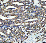 Immunohistochemical staining of SHMT2 using anti-SHMT2 antibody. SHMT2 was detected in a paraffin-embedded section of human thyroid cancer tissue. Heat mediated antigen retrieval was performed in EDTA buffer (pH 8.0, epitope retrieval solution). The tissue section was blocked with 10% goat serum. The tissue section was then incubated with 2 ug/ml rabbit anti-SHMT2 antibody overnight at 4oC. Peroxidase Conjugated Goat Anti-rabbit IgG was used as secondary antibody and incubated for 30 minutes at 37oC. The tissue section was developed using an HRP secondary and DAB substrate.