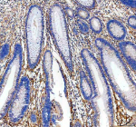 Immunohistochemical staining of TGFBI using anti-TGFBI antibody. TGFBI was detected in a paraffin-embedded section of human colon cancer tissue. Heat mediated antigen retrieval was performed in EDTA buffer (pH 8.0, epitope retrieval solution). The tissue section was blocked with 10% goat serum. The tissue section was then incubated with 2 ug/ml rabbit anti-TGFBI antibody overnight at 4oC. Peroxidase Conjugated Goat Anti-rabbit IgG was used as secondary antibody and incubated for 30 minutes at 37oC. The tissue section was developed using an HRP secondary and DAB substrate.