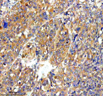 Immunohistochemical staining of RAPH1 using anti-RAPH1 antibody. RAPH1 was detected in a paraffin-embedded section of human liver cancer tissue. Heat mediated antigen retrieval was performed in EDTA buffer (pH 8.0, epitope retrieval solution). The tissue section was blocked with 10% goat serum. The tissue section was then incubated with 2 ug/ml rabbit anti-RAPH1 antibody overnight at 4oC. Peroxidase Conjugated Goat Anti-rabbit IgG was used as secondary antibody and incubated for 30 minutes at 37oC. The tissue section was developed using an HRP secondary and DAB substrate.