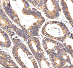 Immunohistochemical staining of NAXE using anti-NAXE antibody. NAXE was detected in a paraffin-embedded section of human colon cancer tissue. Heat mediated antigen retrieval was performed in EDTA buffer (pH 8.0, epitope retrieval solution). The tissue section was blocked with 10% goat serum. The tissue section was then incubated with 2 ug/ml rabbit anti-NAXE antibody overnight at 4oC. Peroxidase Conjugated Goat Anti-rabbit IgG was used as secondary antibody and incubated for 30 minutes at 37oC. The tissue section was developed using an HRP secondary and DAB substrate.