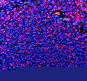 Immunofluorescent staining of TMC6 using anti-TMC6 antibody (red). TMC6 was detected in a paraffin-embedded section of human tonsil tissue. Heat mediated antigen retrieval was performed in EDTA buffer (pH 8.0, epitope retrieval solution). The tissue section was blocked with 10% goat serum. The tissue section was then incubated with 5 ug/ml rabbit anti-TMC6 antibody overnight at 4oC. Cy3 Conjugated Goat Anti-Rabbit IgG was used as secondary antibody at 1:500 dilution and incubated for 30 minutes at 37oC. The section was counterstained with DAPI nuclear stain (blue). Visualize using a fluorescence microscope and filter sets appropriate for the label used.