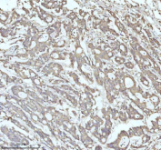 Immunohistochemical staining of MALSU1 using anti-MALSU1 antibody. MALSU1 was detected in a paraffin-embedded section of human colon adenocarcinoma tissue. Heat mediated antigen retrieval was performed in EDTA buffer (pH 8.0, epitope retrieval solution). The tissue section was blocked with 10% goat serum. The tissue section was then incubated with 2 ug/ml rabbit anti-MALSU1 antibody overnight at 4oC. Peroxidase Conjugated Goat Anti-rabbit IgG was used as secondary antibody and incubated for 30 minutes at 37oC. The tissue section was developed using an HRP secondary and DAB substrate.