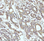 Immunohistochemical staining of MALSU1 using anti-MALSU1 antibody. MALSU1 was detected in a paraffin-embedded section of human colon adenocarcinoma tissue. Heat mediated antigen retrieval was performed in EDTA buffer (pH 8.0, epitope retrieval solution). The tissue section was blocked with 10% goat serum. The tissue section was then incubated with 2 ug/ml rabbit anti-MALSU1 antibody overnight at 4oC. Peroxidase Conjugated Goat Anti-rabbit IgG was used as secondary antibody and incubated for 30 minutes at 37oC. The tissue section was developed using an HRP secondary and DAB substrate.