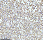 Immunohistochemical staining of MALSU1 using anti-MALSU1 antibody. MALSU1 was detected in a paraffin-embedded section of human liver cancer tissue. Heat mediated antigen retrieval was performed in EDTA buffer (pH 8.0, epitope retrieval solution). The tissue section was blocked with 10% goat serum. The tissue section was then incubated with 2 ug/ml rabbit anti-MALSU1 antibody overnight at 4oC. Peroxidase Conjugated Goat Anti-rabbit IgG was used as secondary antibody and incubated for 30 minutes at 37oC. The tissue section was developed using an HRP secondary and DAB substrate.