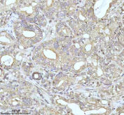 Immunohistochemical staining of MALSU1 using anti-MALSU1 antibody. MALSU1 was detected in a paraffin-embedded section of human prostate adenocarcinoma tissue. Heat mediated antigen retrieval was performed in EDTA buffer (pH 8.0, epitope retrieval solution). The tissue section was blocked with 10% goat serum. The tissue section was then incubated with 2 ug/ml rabbit anti-MALSU1 antibody overnight at 4oC. Peroxidase Conjugated Goat Anti-rabbit IgG was used as secondary antibody and incubated for 30 minutes at 37oC. The tissue section was developed using an HRP secondary and DAB substrate.