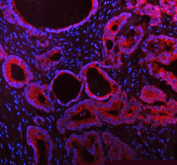 Immunofluorescent staining of FFPE human colon cancer tissue with MALSU1 antibody (red) and DAPI nuclear stain (blue). HIER: steam section in pH8 EDTA buffer for 20 min.