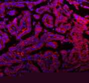 Immunofluorescent staining of FFPE human lung cancer tissue with MALSU1 antibody (red) and DAPI nuclear stain (blue). HIER: steam section in pH8 EDTA buffer for 20 min.