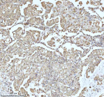 Immunohistochemical staining of MALSU1 using anti-MALSU1 antibody. MALSU1 was detected in a paraffin-embedded section of human lung adenocarcinoma tissue. Heat mediated antigen retrieval was performed in EDTA buffer (pH 8.0, epitope retrieval solution). The tissue section was blocked with 10% goat serum. The tissue section was then incubated with 2 ug/ml rabbit anti-MALSU1 antibody overnight at 4oC. Peroxidase Conjugated Goat Anti-rabbit IgG was used as secondary antibody and incubated for 30 minutes at 37oC. The tissue section was developed using an HRP secondary and DAB substrate.