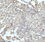 Immunohistochemical staining of MALSU1 using anti-MALSU1 antibody. MALSU1 was detected in a paraffin-embedded section of human lung adenocarcinoma tissue. Heat mediated antigen retrieval was performed in EDTA buffer (pH 8.0, epitope retrieval solution). The tissue section was blocked with 10% goat serum. The tissue section was then incubated with 2 ug/ml rabbit anti-MALSU1 antibody overnight at 4oC. Peroxidase Conjugated Goat Anti-rabbit IgG was used as secondary antibody and incubated for 30 minutes at 37oC. The tissue section was developed using an HRP secondary and DAB substrate.