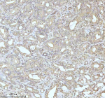 Immunohistochemical staining of MALSU1 using anti-MALSU1 antibody. MALSU1 was detected in a paraffin-embedded section of human prostate adenocarcinoma tissue. Heat mediated antigen retrieval was performed in EDTA buffer (pH 8.0, epitope retrieval solution). The tissue section was blocked with 10% goat serum. The tissue section was then incubated with 2 ug/ml rabbit anti-MALSU1 antibody overnight at 4oC. Peroxidase Conjugated Goat Anti-rabbit IgG was used as secondary antibody and incubated for 30 minutes at 37oC. The tissue section was developed using an HRP secondary and DAB substrate.