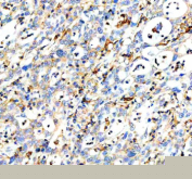 Immunohistochemical staining of DOCK8 using anti-DOCK8 antibody. DOCK8 was detected in a paraffin-embedded section of human pancreas cancer tissue. Heat mediated antigen retrieval was performed in EDTA buffer (pH 8.0, epitope retrieval solution). The tissue section was blocked with 10% goat serum. The tissue section was then incubated with 2 ug/ml rabbit anti-DOCK8 antibody overnight at 4oC. Peroxidase Conjugated Goat Anti-rabbit IgG was used as secondary antibody and incubated for 30 minutes at 37oC. The tissue section was developed using an HRP secondary and DAB substrate.