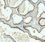 Immunohistochemical staining of BCAP29 using anti-BCAP29 antibody. BCAP29 was detected in a paraffin-embedded section of human prostatic acinar adenocarcinoma tissue. Heat mediated antigen retrieval was performed in EDTA buffer (pH 8.0, epitope retrieval solution). The tissue section was blocked with 10% goat serum. The tissue section was then incubated with 2 ug/ml rabbit anti-BCAP29 antibody overnight at 4oC. Peroxidase Conjugated Goat Anti-rabbit IgG was used as secondary antibody and incubated for 30 minutes at 37oC. The tissue section was developed using an HRP secondary and DAB substrate.